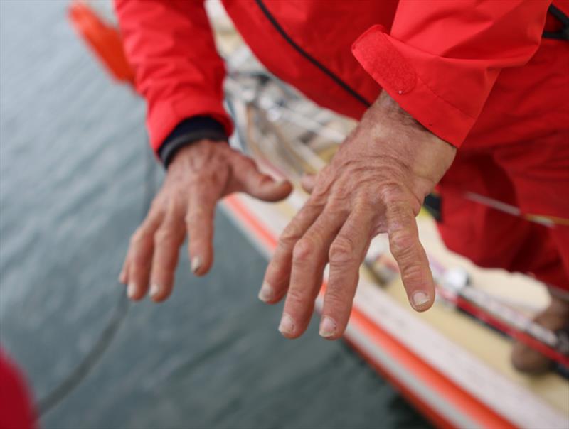 Kopar's hands are suffering from what appears to be a fungal infection from his time at sea photo copyright Jessie Martin / PPL / GGR taken at  and featuring the Golden Globe Race class
