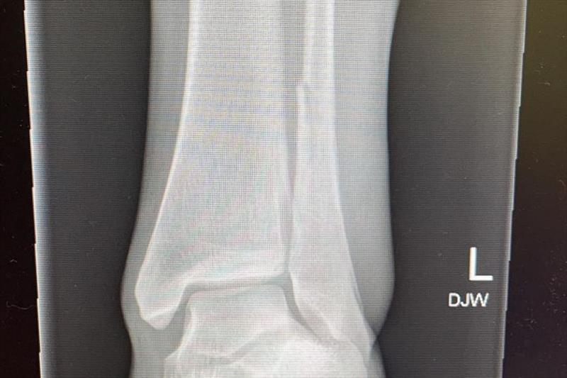 X-rays revealed a fractured fibula. Main photo: photo copyright Photo supplied taken at Royal Akarana Yacht Club and featuring the Nacra 17 class